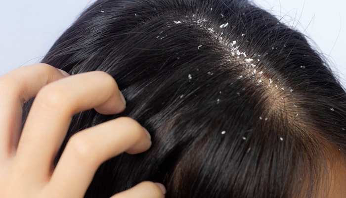 dandruff